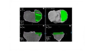 術前3D模擬計畫