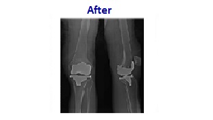 機器手臂手術全膝關節置換後